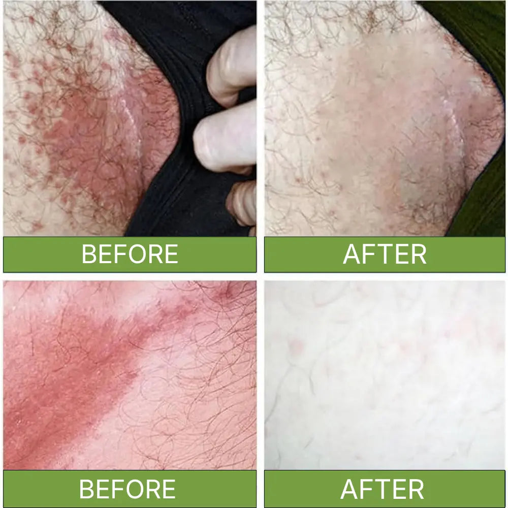 Zelyxov Antifungal & Allergy Soap™ - Zelyxov