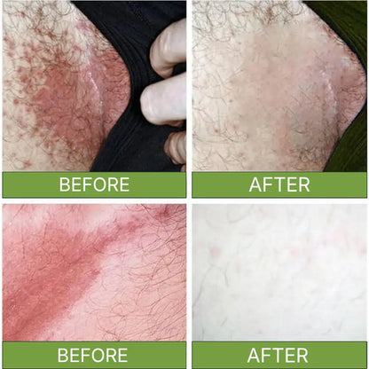 Zelyxov Antifungal & Allergy Soap™ - Zelyxov